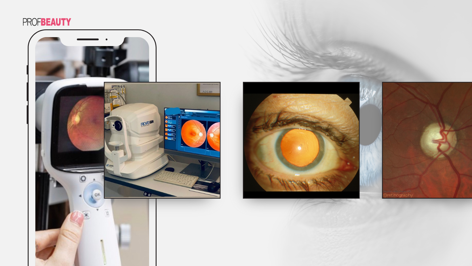 Tầm quan trọng của việc soi đáy mắt dành cho các chị em cận thị