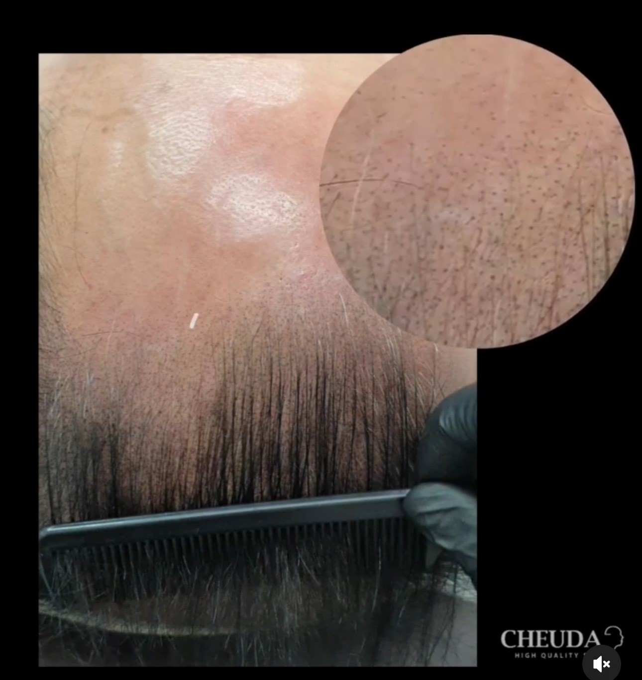 master-chakra-ling-se-trinh-dien-ky-thuat-vi-cham-sac-to-da-dau-tai-royal-pmu-5