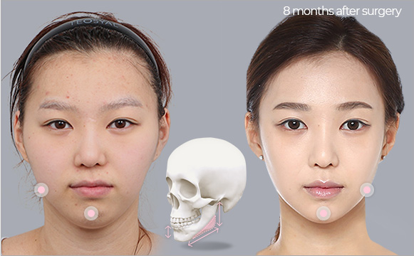 Phẫu thuật đường viền khuôn mặt giúp làm căng da mặt, đem lại vẻ đẹp trẻ hoá một cách thần kỳ